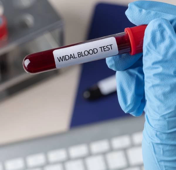 Widal Blood Test - Uses, Purpose, Procedure, & Range