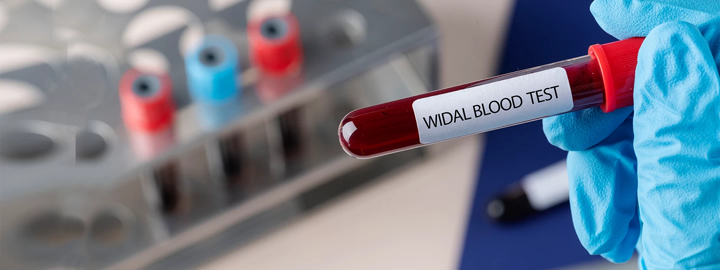 Widal Blood Test - Uses, Purpose, Procedure, & Range